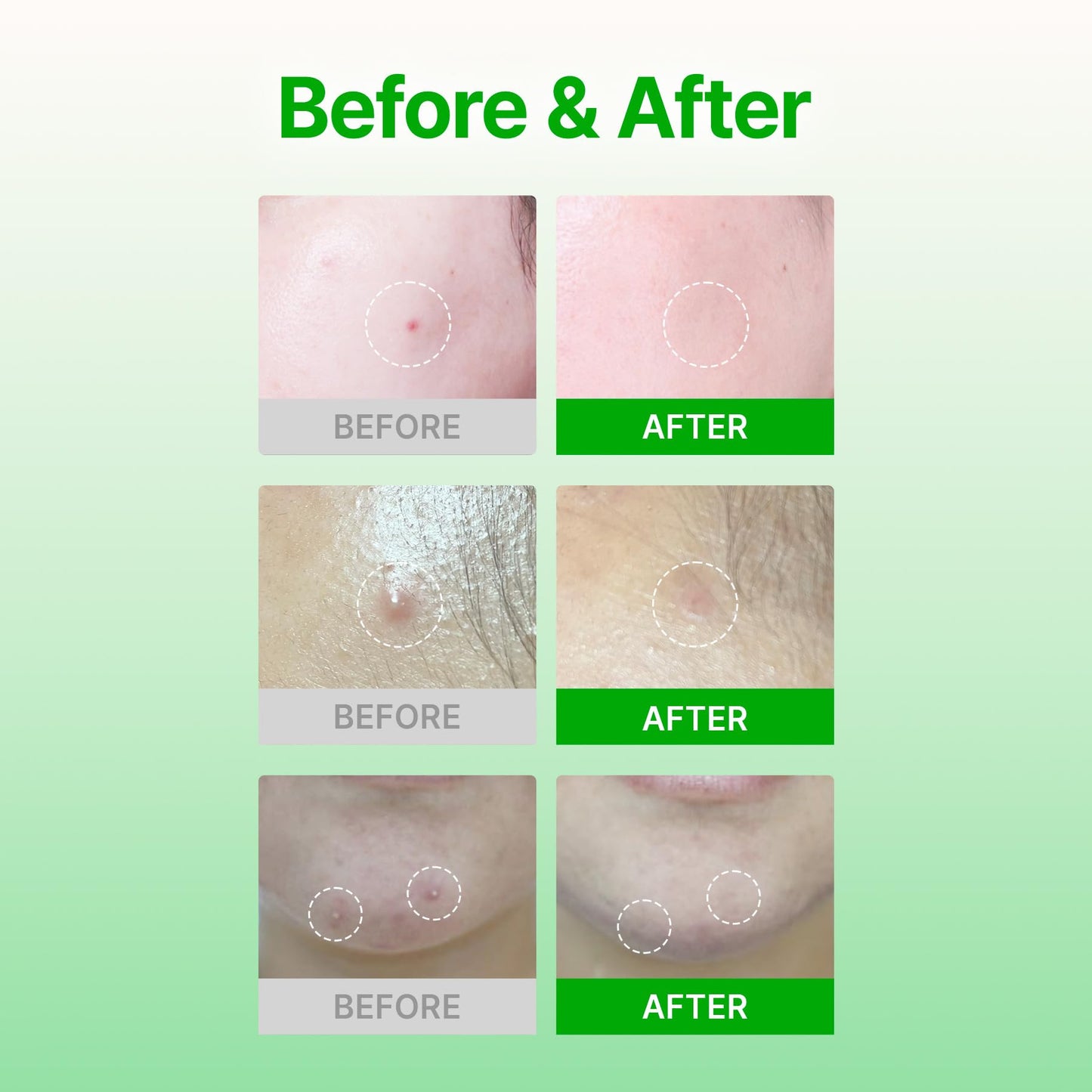 Acropass Trouble Care Microcone Acne Patch for Early Stage Pimple and Zits - Hydrocolloid, Niacimide Pimple Spot Treatment