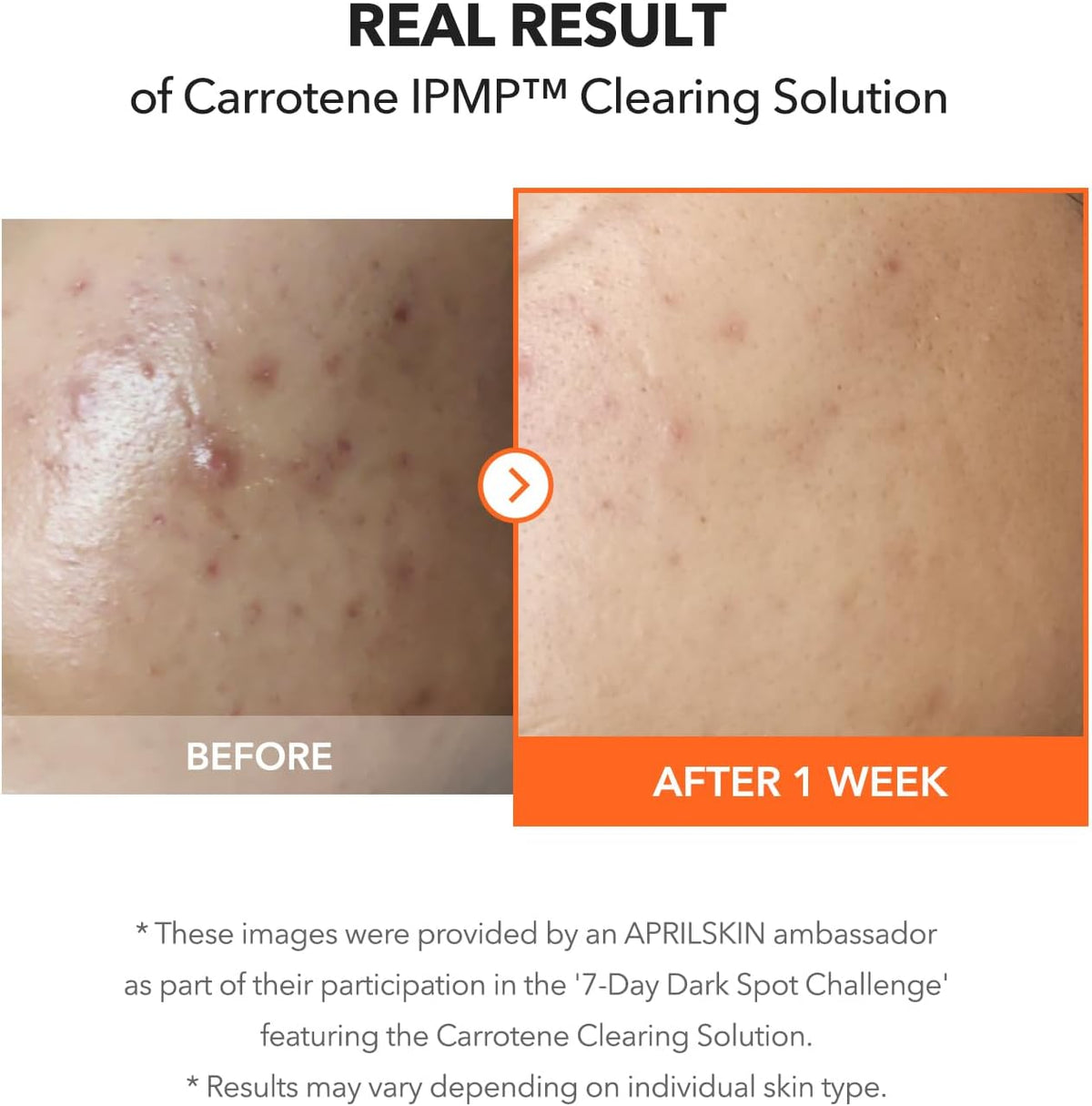 APRILSKIN Carrotene IPMP™ Clearing Solution 20ml